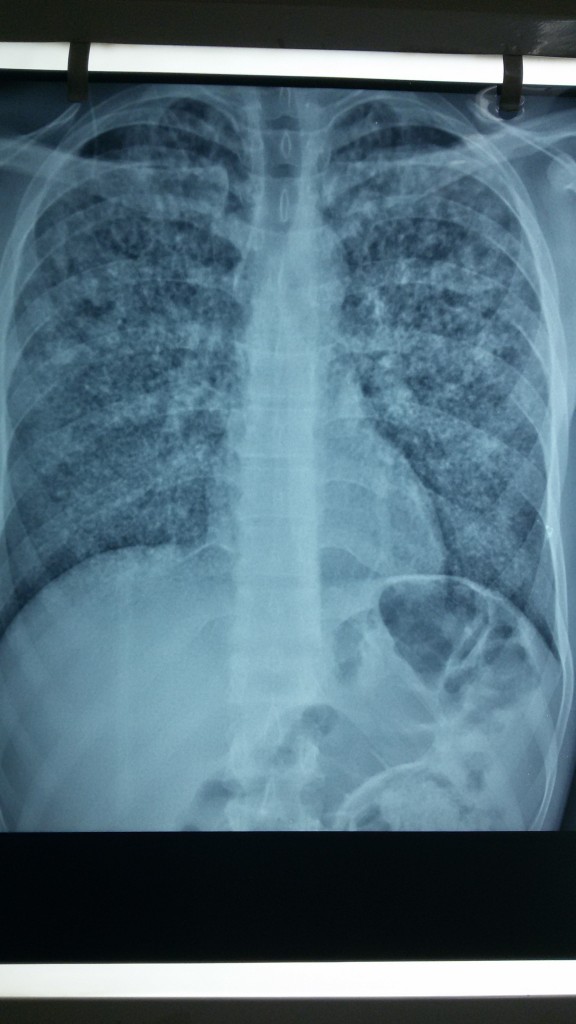 ακτινογραφία θώρακος μετανάστη κρατούμενου με φυματίωση ειδικευόμενοι eidikeuomenoi