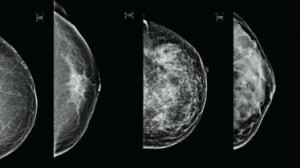 Πυκνότητα μαστού. Ειδικευόμενοι. eidikeyomenoi. eidikeuomenoi