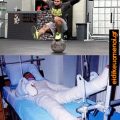 Με το crossfit άλλαξε η ζωή μου. Άνδρας σηκώνει βάρη πάνω σε μπάλα ισορροπία, μετά έχει ολόσωμο γύψο στο κρεββάτι. Ειδικευόμενοι
